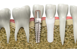 All Ceramic Implants - Dental Implant Services Plymouth