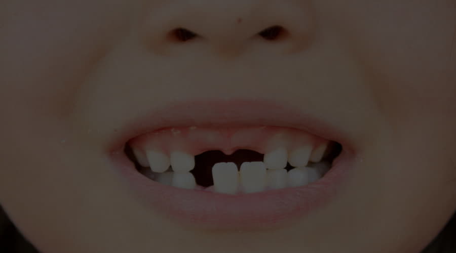 What is the minimum age to place dental implants Smile Care