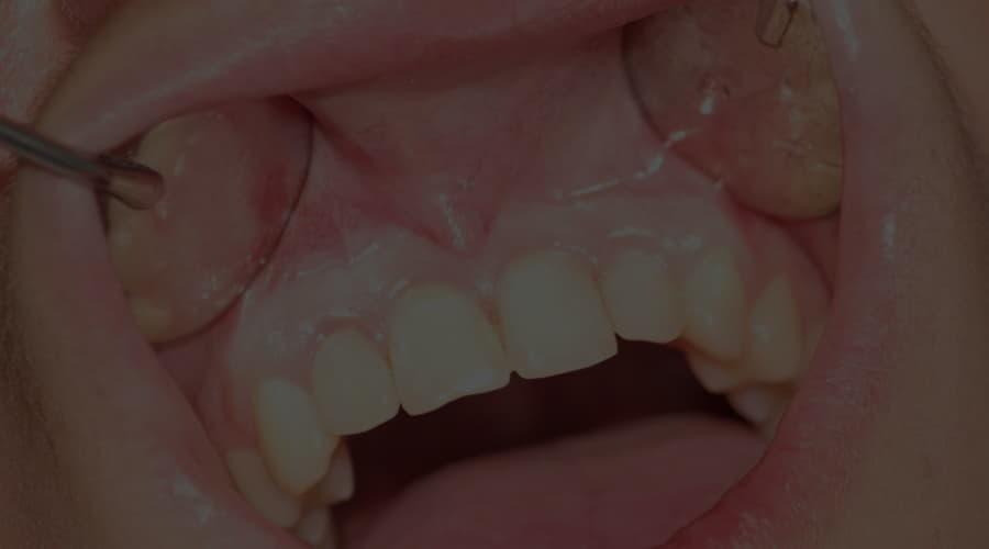 White gums causes Smile Care Plymouth Smile Care