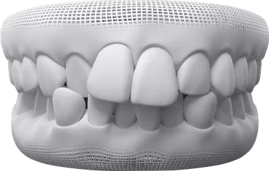 Generally Crowded Teeth