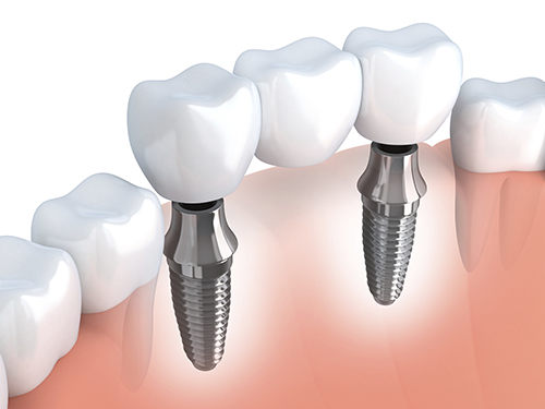 Dental Implants