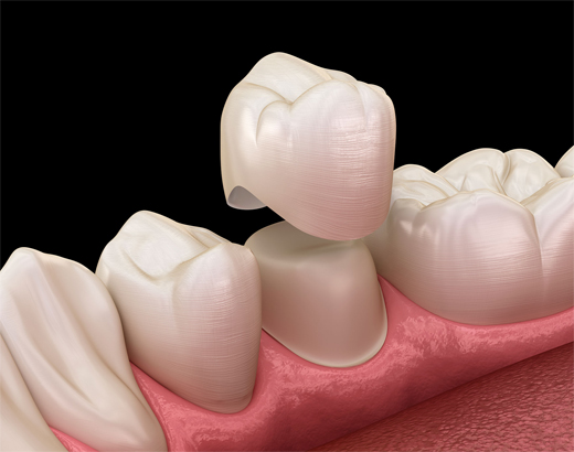 SmileCare Plymouth Dental Crowns