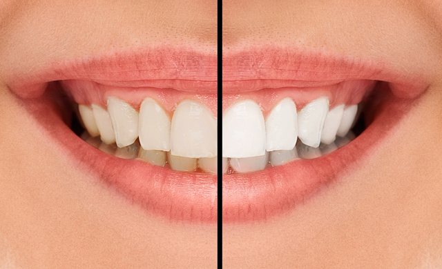 Teeth Whitening SmileCare Plymouth